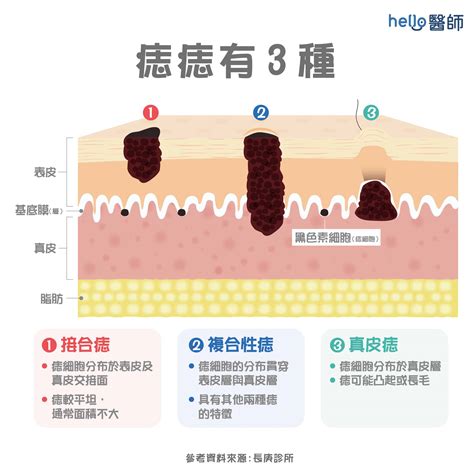 陰莖 長痣